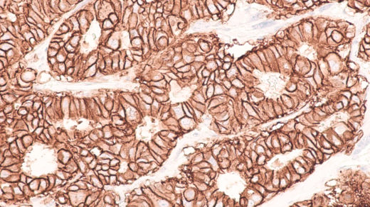 Photomicrograph of immunohistochemistry for HER2, showing positive cell membrane staining in this infiltrating ductal carcinoma