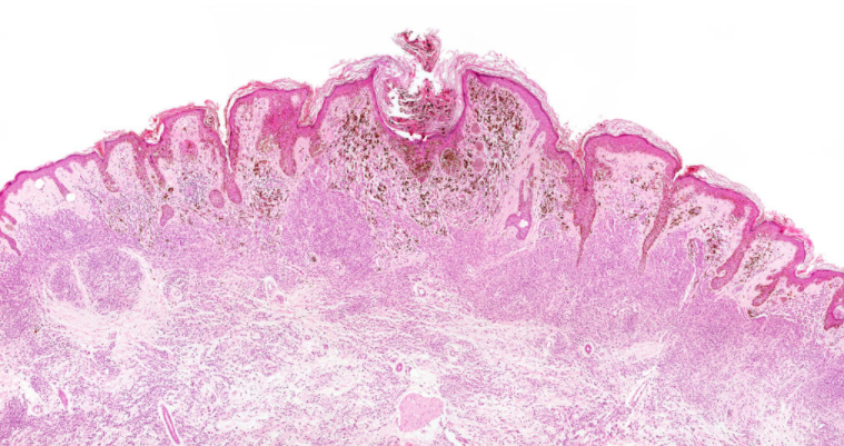 Malignant melanoma under the microscope.