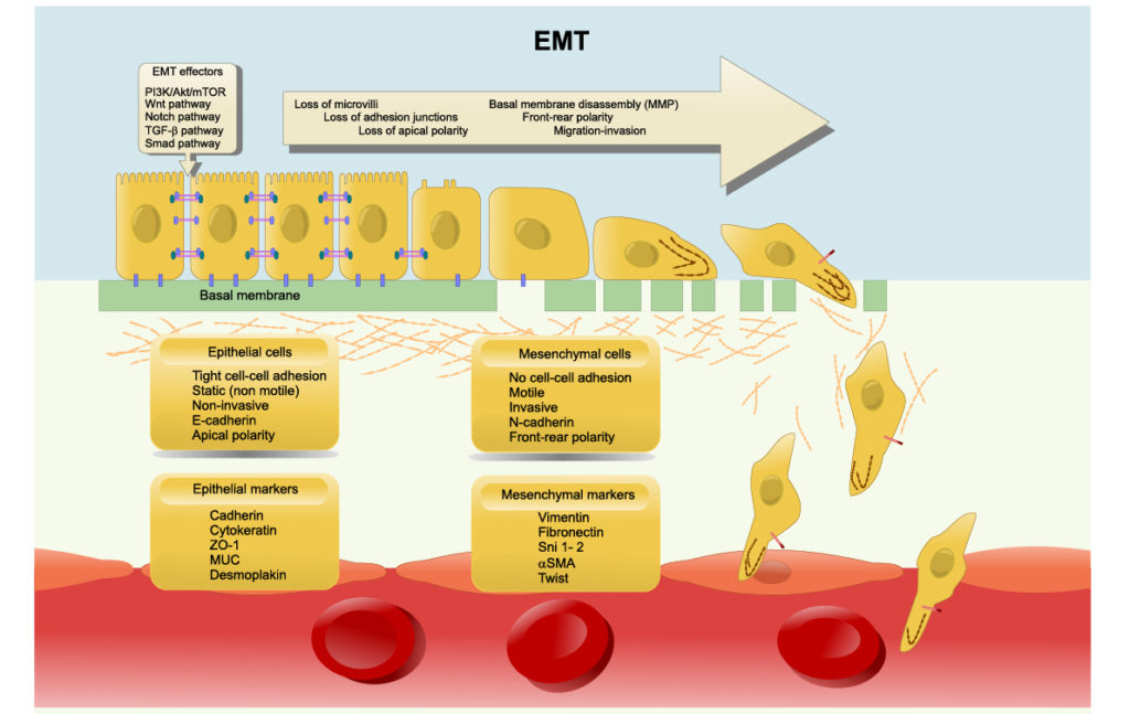 Epithelial–mesenchymal transition (EMT): losing cell polarity and cell adhesion to gain migratory and invasive properties.