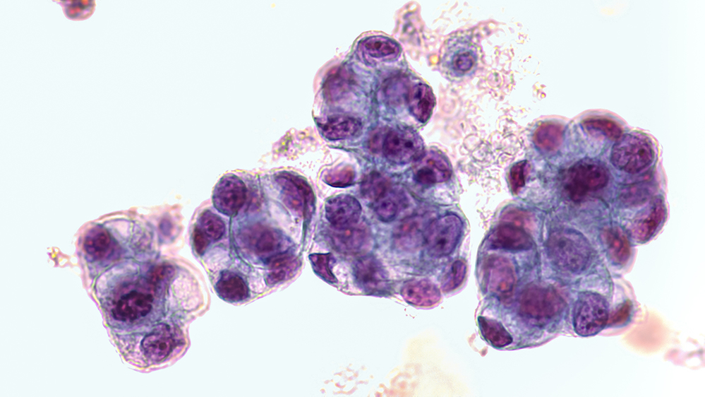 Malignant fluid cytology; Malignant cells of adenocarcinoma may spread to fluid of pleural or peritoneal cavity in cancer from the breast, lung, colon, pancreas, ovary, endometrium or other sites.