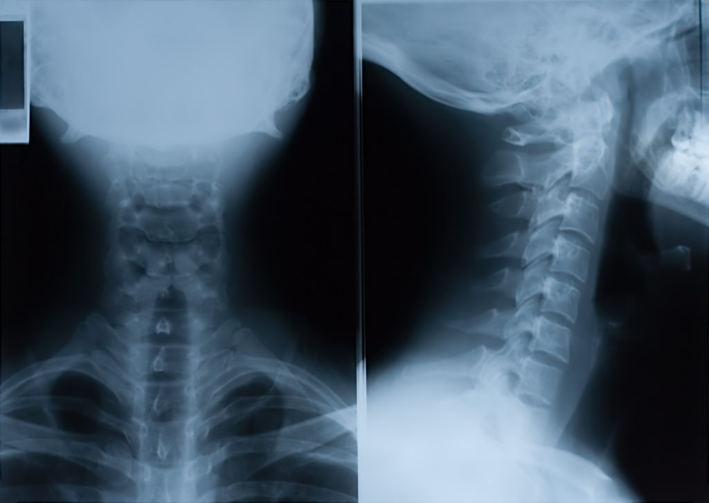 X-Ray film of neck - front and side
