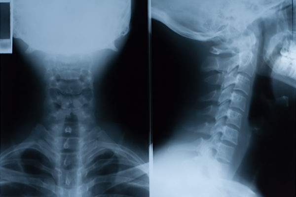 X-Ray film of neck - front and side