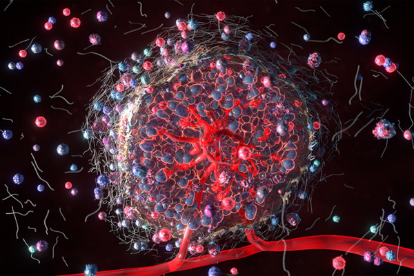 Immunotherapy Response in Primary vs Metastatic Pancreatic Cancer